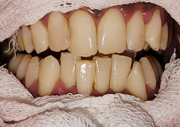 Cosmetic Dentistry - Before